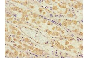 Immunohistochemistry of paraffin-embedded human gastric cancer using ABIN7173562 at dilution of 1:100 (Tropomyosin 4 antibody  (AA 1-248))
