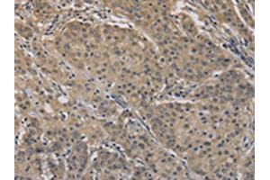 The image on the left is immunohistochemistry of paraffin-embedded Human gastric cancer tissue using ABIN7128303(AGTRAP Antibody) at dilution 1/40, on the right is treated with fusion protein. (AGTRAP antibody)
