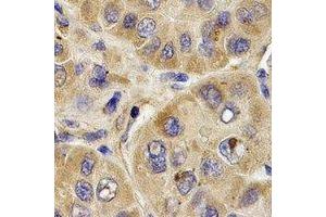 Immunohistochemical analysis of PYGB staining in human liver cancer formalin fixed paraffin embedded tissue section. (PYGB antibody)