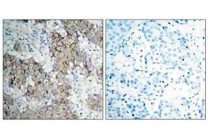 Immunohistochemical analysis of paraffin- embedded human breast carcinoma tissue using IGF-1R (phospho-Tyr1161) antibody. (IGF1R antibody  (pTyr1161))