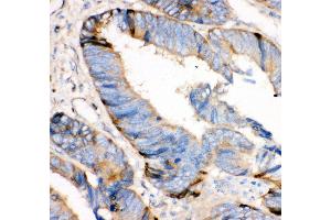 Anti- HRG antibody, IHC(P) IHC(P): Human Intestinal Cancer Tissue