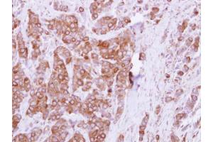 IHC-P Image Immunohistochemical analysis of paraffin-embedded human breast cancer, using OCRL, antibody at 1:250 dilution.