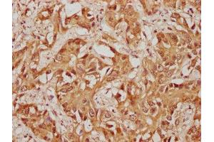 IHC image of ABIN7174320 diluted at 1:100 and staining in paraffin-embedded human liver cancer performed on a Leica BondTM system. (USP36 antibody  (AA 670-881))