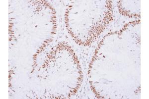 IHC-P Image ZNF198 antibody detects ZNF198 protein at nucleus on human colon carcinoma by immunohistochemical analysis. (ZMYM2 antibody  (Center))