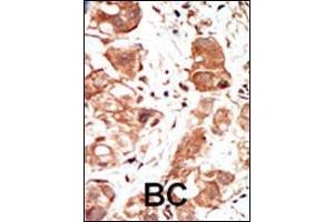 Formalin-fixed and paraffin-embedded human cancer tissue reacted with the primary antibody, which was peroxidase-conjugated to the secondary antibody, followed by DAB staining. (PIM1 antibody  (C-Term))