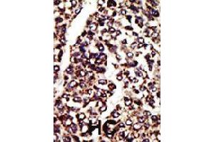 Formalin-fixed and paraffin-embedded human hepatocellular carcinoma tissue reacted with AGER polyclonal antibody  , which was peroxidase-conjugated to the secondary antibody, followed by AEC staining . (RAGE antibody  (C-Term))
