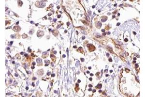 ABIN6267475 at 1/100 staining human breast carcinoma tissue sections by IHC-P.