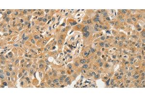 Immunohistochemistry of paraffin-embedded Human lung cancer tissue using SLC11A2 Polyclonal Antibody at dilution 1:50 (SLC11A2 antibody)