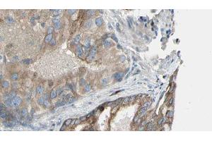 ABIN6272911 at 1/100 staining Human prostate tissue by IHC-P. (Choline Kinase alpha antibody  (Internal Region))