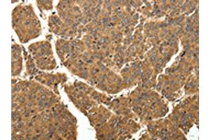 The image on the left is immunohistochemistry of paraffin-embedded Human liver cancer tissue using ABIN7129340(EIF2AK3 Antibody) at dilution 1/40, on the right is treated with fusion protein. (COQ3 antibody)
