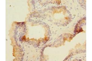Immunohistochemistry of paraffin-embedded human prostate cancer using ABIN7160074 at dilution of 1:100