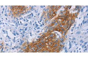 Immunohistochemistry of paraffin-embedded Human esophagus cancer tissue using CCR9 Polyclonal Antibody at dilution 1:60 (CCR9 antibody)