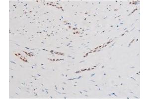 ABIN6267579 at 1/200 staining Human bladder cancer tissue sections by IHC-P. (FOXO4 antibody  (pSer197))