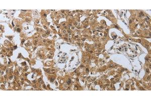 Immunohistochemistry of paraffin-embedded Human lung cancer using PSMD6 Polyclonal Antibody at dilution of 1:40 (PSMD6 antibody)