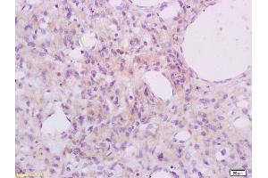 Formalin-fixed and paraffin embedded human cervical carcinoma labeled with Anti Phospho-S6 Ribosomal Protein (Ser235+Ser236) Polyclonal Antibody, Unconjugated (ABIN745583) at 1:200 followed by conjugation to the secondary antibody and DAB staining (RPS6 antibody  (pSer235, pSer236))