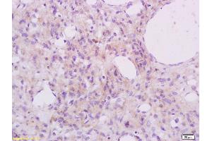 Formalin-fixed and paraffin embedded human cervical carcinoma labeled with Anti Phospho-S6 Ribosomal Protein (Ser235+Ser236) Polyclonal Antibody, Unconjugated (ABIN745583) at 1:200 followed by conjugation to the secondary antibody and DAB staining