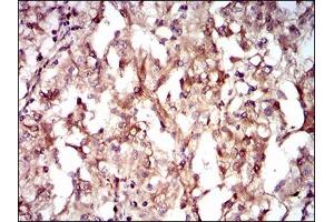 Immunohistochemical analysis of paraffin-embedded renal cancer tissues using GUCY1A3 mouse mAb with DAB staining. (GUCY1A1 antibody  (AA 22-214))