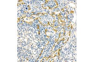Immunohistochemistry of paraffin embedded human lung cancer using MRP1 (ABIN7074544) at dilution of 1:1000 (200x lens) (MRP1 antibody)