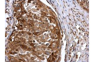 IHC-P Image IFIT3 antibody detects IFIT3 protein at cytoplasm in human cervical carcinoma by immunohistochemical analysis.