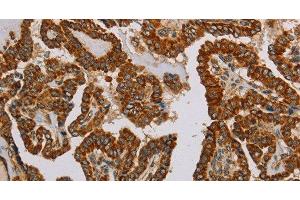Immunohistochemistry of paraffin-embedded Human thyroid cancer using NDUFS5 Polyclonal Antibody at dilution of 1:50 (NDUFS5 antibody)