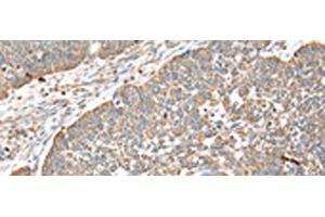 Immunohistochemistry of paraffin-embedded Human lung cancer tissue using DPH7 Polyclonal Antibody at dilution of 1:40(x200) (Diphthamide Biosynthesis 7 (DPH7) antibody)