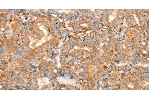 Immunohistochemistry of paraffin-embedded Human thyroid cancer using SLC16A8 Polyclonal Antibody at dilution of 1:40 (MCT3 antibody)