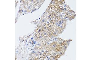 Immunohistochemistry of paraffin-embedded human liver cancer using GN Rabbit pAb (ABIN3023414, ABIN3023415, ABIN3023416 and ABIN6219781) at dilution of 1:150 (40x lens). (GNA11 antibody)