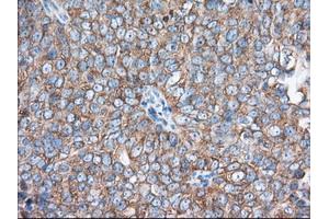 Immunohistochemical staining of paraffin-embedded Adenocarcinoma of Human colon tissue using anti-EIF2S1 mouse monoclonal antibody. (EIF2S1 antibody)