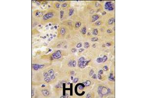 Formalin-fixed and paraffin-embedded human hepatocarcinoma tissue reacted with PFKFB1 antibody (N-term), which was peroxidase-conjugated to the secondary antibody, followed by DAB staining. (PFKFB1 antibody  (N-Term))