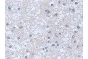 Detection of GUCY1b3 in Human Glioma Tissue using Polyclonal Antibody to Guanylate Cyclase 1 Beta 3 (GUCY1b3) (GUCY1B3 antibody  (AA 408-619))