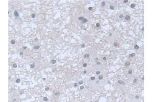 Detection of GUCY1b3 in Human Glioma Tissue using Polyclonal Antibody to Guanylate Cyclase 1 Beta 3 (GUCY1b3)