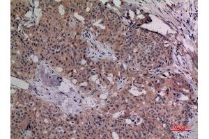 Immunohistochemistry (IHC) analysis of paraffin-embedded Human Breast Cancer, antibody was diluted at 1:100. (IL-4 antibody  (Internal Region))