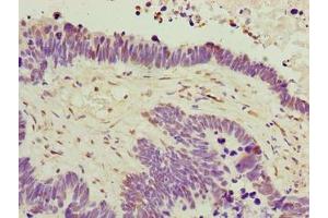 Immunohistochemistry of paraffin-embedded human ovarian cancer using ABIN7174864 at dilution of 1:100 (C6orf141 antibody  (AA 1-237))