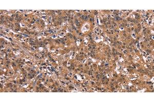 Immunohistochemistry of paraffin-embedded Human liver cancer tissue using NOS2 Polyclonal Antibody at dilution 1:40 (NOS2 antibody)