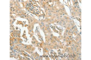 Immunohistochemistry of Human lung cancer using ACE Polyclonal Antibody at dilution of 1:70 (Angiotensin I Converting Enzyme 1 antibody)