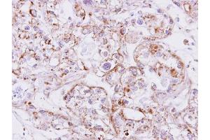 IHC-P Image Immunohistochemical analysis of paraffin-embedded CLEAR CELL OVCA xenograft, using Inhibin beta A, antibody at 1:500 dilution.