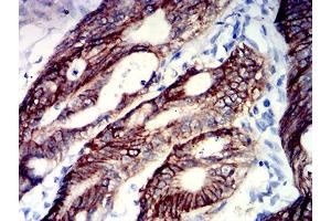 Immunohistochemical analysis of paraffin-embedded colon cancer tissues using TNFRSF18 mouse mAb with DAB staining.