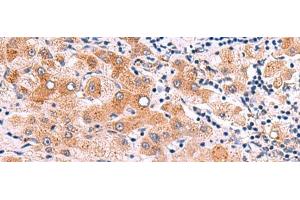 Immunohistochemistry of paraffin-embedded Human liver cancer tissue using ITGA11 Polyclonal Antibody at dilution of 1:75(x200) (ITGA11 antibody)