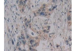 Detection of MPG1 in Human Pancreatic cancer Tissue using Polyclonal Antibody to Macrophage Expressed Gene 1 Protein (MPG1) (MPEG1 antibody  (AA 313-580))