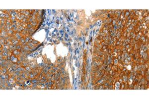Immunohistochemistry of paraffin-embedded Human cervical cancer tissue using VWA5A Polyclonal Antibody at dilution 1:80 (VWA5A antibody)