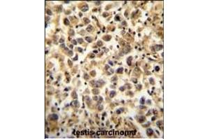 CCDC19 Antibody (N-term) (ABIN654396 and ABIN2844138) immunohistochemistry analysis in formalin fixed and paraffin embedded human testis carcinoma followed by peroxidase conjugation of the secondary antibody and DAB staining. (CCDC19 antibody  (N-Term))