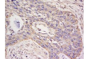 Paraformaldehyde-fixed, paraffin embedded human lung cancer, Antigen retrieval by boiling in sodium citrate buffer (pH6) for 15min, Block endogenous peroxidase by 3% hydrogen peroxide for 30 minutes, Blocking buffer (normal goat serum) at 37°C for 20min, Antibody incubation with Rabbit Anti-CD85c Polyclonal Antibody, Unconjugated  at 1:500 overnight at 4°C, followed by a conjugated secondary and DAB staining. (LILRB5 antibody  (AA 151-250))