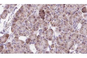ABIN6273226 at 1/100 staining Human pancreas cancer tissue by IHC-P. (DIO1 antibody  (C-Term))