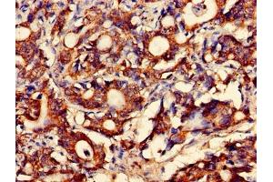 Immunohistochemistry of paraffin-embedded human gastric cancer using ABIN7160449 at dilution of 1:100 (FAM168B antibody  (AA 43-100))