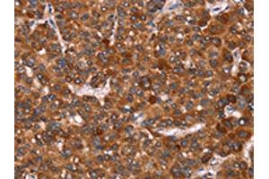 The image on the left is immunohistochemistry of paraffin-embedded Human liver cancer tissue using ABIN7190739(GAGE12I Antibody) at dilution 1/20, on the right is treated with synthetic peptide. (G Antigen 12I antibody)