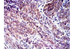Immunohistochemical analysis of paraffin-embedded cervical cancer tissues using CD9 mouse mAb with DAB staining. (CD9 antibody)
