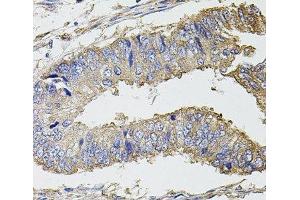 Immunohistochemistry of paraffin-embedded Human colon carcinoma using UBE2S Polyclonal Antibody at dilution of 1:100 (40x lens). (UBE2S antibody)