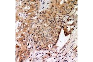 Immunohistochemical analysis of TAGAP staining in human breast cancer formalin fixed paraffin embedded tissue section. (TAGAP antibody)