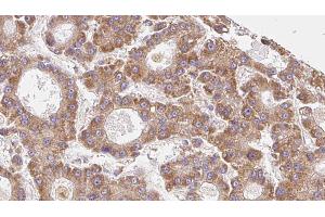 ABIN6273962 at 1/100 staining Human liver cancer tissue by IHC-P. (OR6C75 antibody)