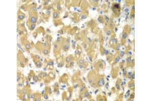 Immunohistochemistry of paraffin-embedded Human liver damage using MAP4K3 Polyclonal Antibody at dilution of 1:100 (40x lens).